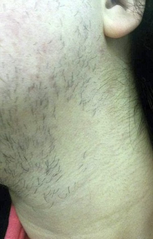 Lông mọc dày trên mặt, cổ, ngực, bụng và chân cô. Anh trai John của Cheryl phải dạy cô cách cạo râu.