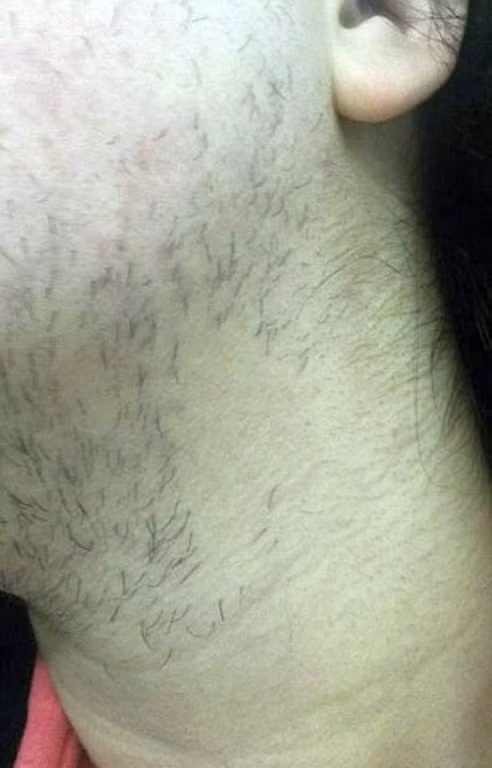 Lông mọc dày trên mặt, cổ, ngực, bụng và chân cô. Anh trai John của Cheryl phải dạy cô cách cạo râu.