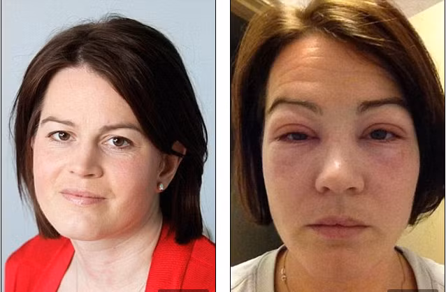 Hong giac mac, mu mat vi bien chung khi noi mi-Hinh-4