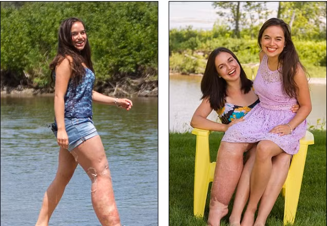 Chân phải của thiếu nữ này nặng tới 18kg, to gấp đôi chân trái khiến cô không thể mặc quần jean bó sát cũng như chơi các môn thể thao.