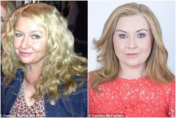 Thực tế, có nhiều phụ nữ đã trải nghiệm việc tiêm botox lên da đầu. Một trong số đó là Giám đốc Marketing Michelle MacCormack, 44 tuổi, đến từ Sutton Coldfield, đã từng vô cùng tuyệt vọng vì mái tóc vàng dày và xơ rối của mình. Hàng ngày, cô phải dành một khoảng thời gian không hề nhỏ để tạo kiểu cho tóc của mình. Sau khi tiêm botox lên da đầu, cô hoàn toàn thỏa mãn với mái tóc mượt mà của mình.