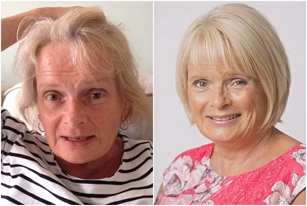 Sue Callan cũng là một trong những khách hàng cảm thấy hài lòng sau khi tiêm botox lên da đầu.