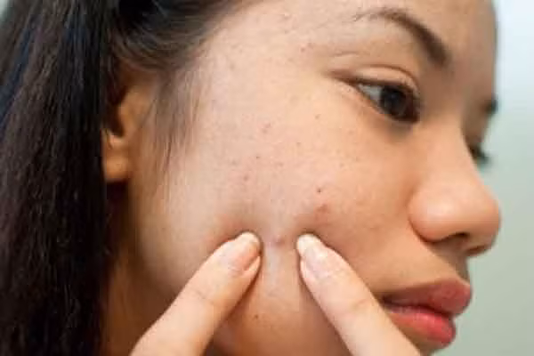  Đắp mặt nạ ngay sau khi nặn mụn. Đây là một trong những sai lầm khi đắp mặt nạ trị mụn nguy hiểm nhất. Khi vừa nặn mụn xong, các vi khuẩn, bã nhờn, chất bẩn vẫn còn ở lại trên da. Đắp mặt nạ lúc này có thể làm cho chúng quay ngược trở lại bên trong da, khiến tình trạng mụn càng nghiêm trọng. Không chỉ thế, nếu bạn đắp mặt nạ khi vừa nặn mụn xong, một số chất trong mặt nạ có thể phản ứng với phần da hở (ở vị trí mụn), gây kích ứng và làm tổn thương da.