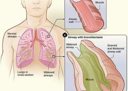 Giãn phế quản. Ngoài lao phổi và ung thư phổi, giãn phế quản cũng là một trong các nguyên nhân thường gặp gây ho ra máu. Đặc tính của ho ra máu trong giãn phế quản là ho ra máu lượng ít, tự cầm trong vòng 3 - 5 ngày, tái đi tái lại nhiều lần, đặc biệt là những khi bị cảm cúm dẫn đến nhiễm khuẩn đường hô hấp, bệnh nhân thường có cảm giác tức, nóng trong ngực và phải ho bật mạnh ra thì có một chút máu, một số bệnh nhân ho ra máu khi vận động, gắng sức.