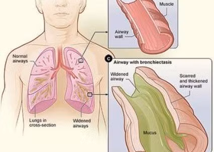 Giãn phế quản. Ngoài lao phổi và ung thư phổi, giãn phế quản cũng là một trong các nguyên nhân thường gặp gây ho ra máu. Đặc tính của ho ra máu trong giãn phế quản là ho ra máu lượng ít, tự cầm trong vòng 3 - 5 ngày, tái đi tái lại nhiều lần, đặc biệt là những khi bị cảm cúm dẫn đến nhiễm khuẩn đường hô hấp, bệnh nhân thường có cảm giác tức, nóng trong ngực và phải ho bật mạnh ra thì có một chút máu, một số bệnh nhân ho ra máu khi vận động, gắng sức.
