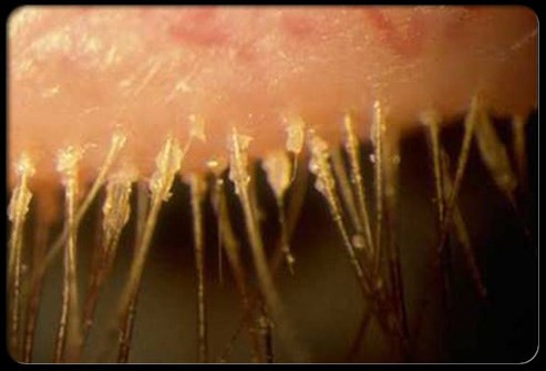 Viêm bờ mi. Nếu không tẩy chuốt mi trước khi đi ngủ, lớp mascara sẽ làm tắc nghẽn nang lông, gây viêm bờ mi, vi khuẩn có thể gây viêm kết mạc.