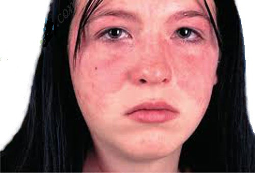 Vết mẩn đỏ. Đây có lẽ là hậu quả ảnh hưởng nặng nề nhất đối với việc ít tẩy trang khi đi ngủ. Nó xuất hiện khi các lỗ chân lông bị nhiễm khuẩn và sưng tấy với hàng tác các chất ứ đọng như kem dưỡng, bã dầu hay bụi bẩn. Tạo nên các vết mẩn đỏ li ti, hay thậm chí là mụn bọc trên mặt.