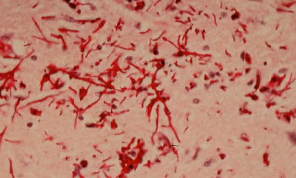 Do nhiễm nấm Candida. Đây có thể được coi là nỗi lo ngại lớn nhất của nam giới khi mắc chứng bệnh này. Khi bị nấm candida tấn công, họ sẽ cảm giác ngứa và nóng ran trong dương vật, đôi khi có cả mủ. Khi mắc bệnh này, nam giới sẽ không bao giờ có cảm giác dễ chịu khi xuất tinh, đi tiểu hoặc thậm chí cả trong sinh hoạt bình thường.