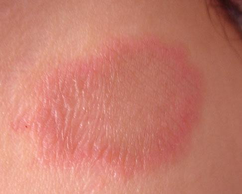 Nhiều người có một vấn đề nào đó về da như bệnh chàm, vảy nến... khiến da thô và không thể đẹp được. Thiếu ngủ sẽ khiến những căn bệnh này càng phát triển và tăng cao. Bởi vậy, cố gắng tạo thói quen ngủ đủ giấc để ngăn ngừa các căn bệnh này phát triển.