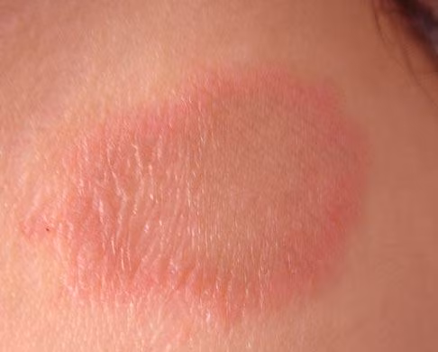 Nhiều người có một vấn đề nào đó về da như bệnh chàm, vảy nến... khiến da thô và không thể đẹp được. Thiếu ngủ sẽ khiến những căn bệnh này càng phát triển và tăng cao. Bởi vậy, cố gắng tạo thói quen ngủ đủ giấc để ngăn ngừa các căn bệnh này phát triển.