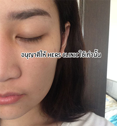 Việc tiến hành thẩm mỹ theo cách hoàn toàn mới này thu hút lượng lớn cư dân mạng sau khi những hình ảnh của cô gái trẻ này được chia sẻ. Đa phần ý kiến cho rằng cô gái này quá may mắn vì gặp được đội ngũ y bác sĩ lành nghề, có kinh nghiệm. 