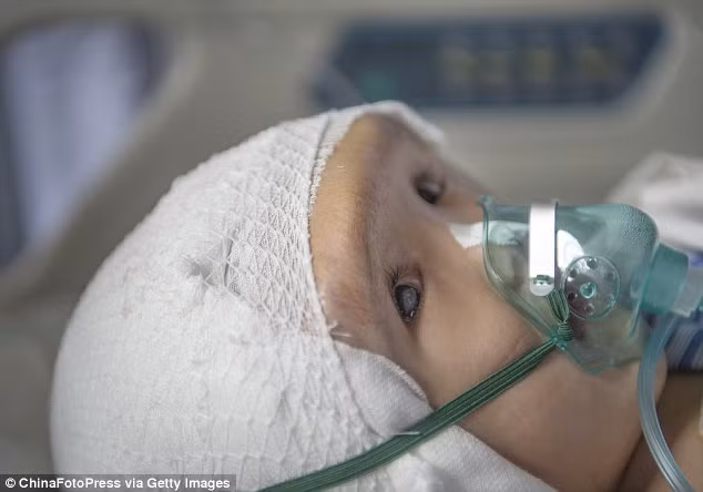 Trước khi phẫu thuật, các bác sĩ chẩn đoán em bé này bị mỏng hộp sọ, máu cung cấp lên não kém. Các bác sĩ cũng cho hay, hộp sọ của cô bé có thể bị vỡ bất cứ lúc nào, nên thực hiện phẫu thuật khẩn cấp là cần thiết.