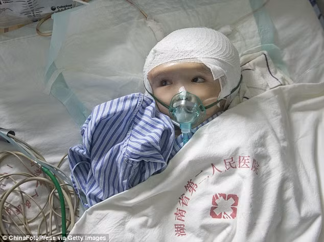 Các bác sĩ đã mất 17 giờ để hoàn thành ca phẫu thuật thu nhỏ não và cấy ghép mô hình hộp sọ 3D vào đầu em bé này, bé đang trong tình trạng phục hồi sau phẫu thuật.