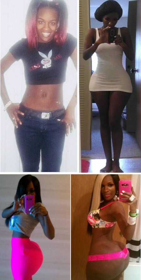 vòng 3 giả biến dạng khó coi. Cô Vanity Wonder, 30 tuổi từ tiểu bang Mid-West từng tiêu tốn 15 nghìn USD (300 triệu đồng) để thực hiện nhiều ca bơm mông tại các cơ sở thẩm mỹ chui. Không may, ca phẫu thuật bị hỏng và nhiễm trùng, dẫn đến vòng 3 của cô bị biến dạng có chu vi tới 1,2 mét.