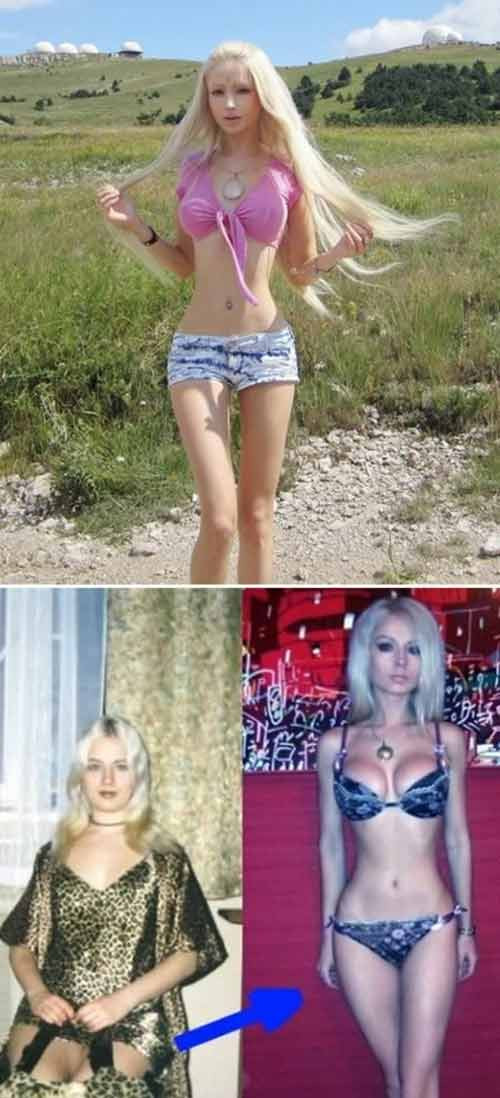 Vòng eo siêu bé kì dị vì cắt xương sườn. Búp bê sống Valeria Lukyanova từng thực hiện hàng loạt ca phẫu thuật nguy hiểm để có ngoại hình giống như cô nàng búp bê barbie. Trong số đó, ca phẫu thuật gây sốc nhất phải kể tới việc cắt xương sườn để tạo vòng eo bé 38 cm.