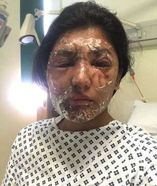 Resham bị chấn thương ở mắt nặng nhất và khuôn mặt cô có thể bị biến dạng. Cô đã thực hiện phẫu thuật cấy ghép da nhưng không ai có thể biết điều gì sẽ xảy đến trong tương lai. Còn Jameel, anh rơi vào tình trạng hôn mê và vừa mới tỉnh lại cách đây không lâu. (Nguồn Youthwant)