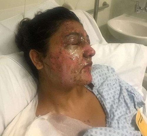 Người đi đường thấy tình trạng khủng khiếp của cả hai anh em Resham đều không thể làm ngơ. Họ nhanh chóng đưa cả hai đến bệnh viện gần nhất để cứu chữa. Sinh nhật của Resham đã trở thành một ngày ám ảnh tồi tệ nhất trong cuộc đời cô. (Nguồn Youthwant)