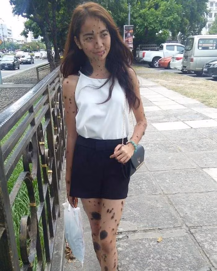 Theo thông tin đăng tải, những mụn nốt ruồi đã xuất hiện trên cơ thể của Evita từ khi cô còn là một đứa trẻ. Qua thời gian, những nốt ruồi ngày càng xuất hiện nhiều và kích thước cũng ngày một lớn. (Nguồn Bored Panda)