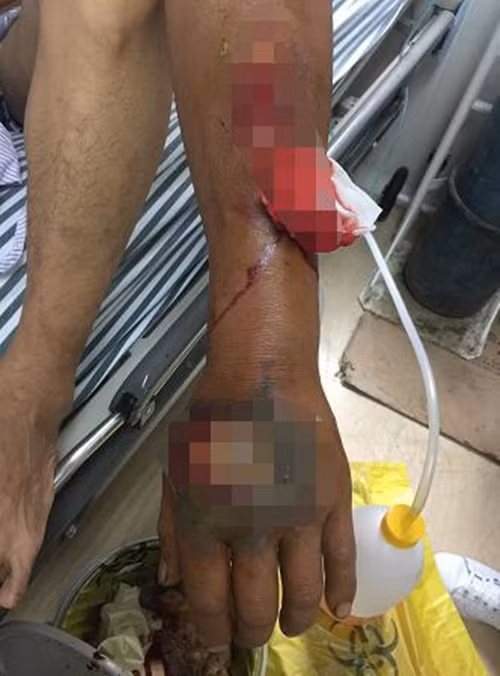 Trên đường đi, Tiểu Lý tức ngực, khó thở, buồn nôn, khó chịu. Khi đến được bệnh viện, chàng thanh niên rơi vào trạng thái nhận thức mơ màng không phản hồi, suy hô hấp cấp tính, được đưa ngay vào phòng cấp cứu khẩn cấp. (Nguồn: Sohu)