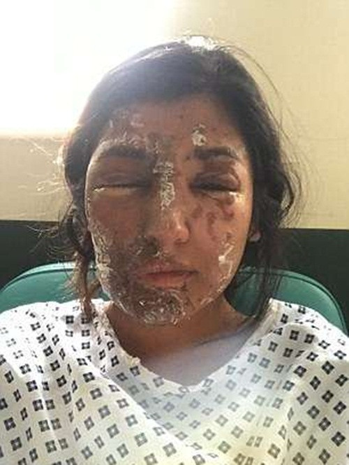 Đau đớn cùng cực, Jameel ngay lập tức lái xe để trốn thoát. Tuy nhiên chẳng được bao lâu, cả hai không thể chịu đựng được sự đau đớn do axit ăn mòn da thịt và buộc phải dừng lại. Cả hai anh em lao khỏi xe, lột hết quần áo với hy vọng người qua đường sẽ giúp họ giảm đau. (Nguồn Youthwant)