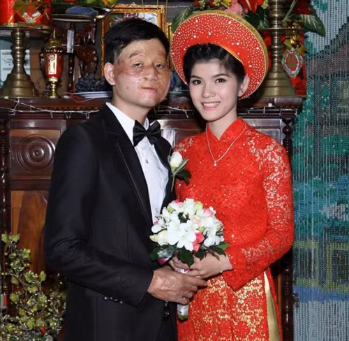 Năm 2014, hình ảnh hôn lễ của chú rể Trần Lâm (sinh năm 1991) và cô dâu Thu Hiền (sinh năm 1993) đến từ TP HCM gây chú ý khi chú rể có khiếm khuyết trên khuôn mặt. Dù nhiều người hoài nghi cả hai đến với nhau vì vật chất, song Thu Hiền đã chứng minh tình yêu của mình khi cặp đôi có một thiên thần nhỏ.