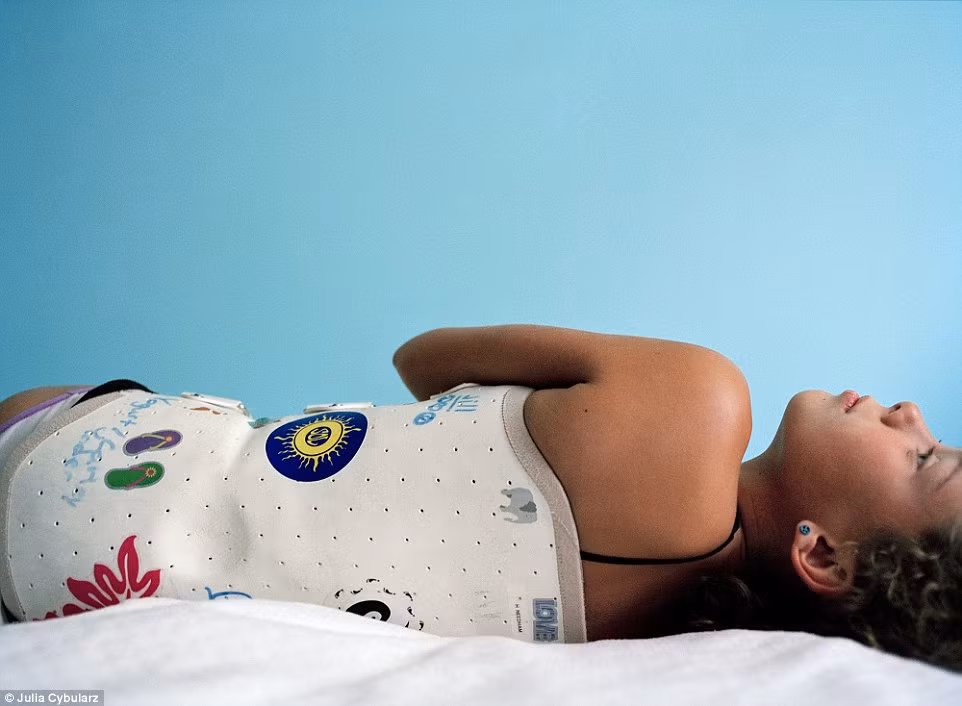 Trước đó, khi phải mặc áo cố định xương, cứ 9 tháng một lần, bác sĩ sẽ phải thay đổi dụng cụ chỉnh hình theo sự phát triển của cơ thể Hannah.