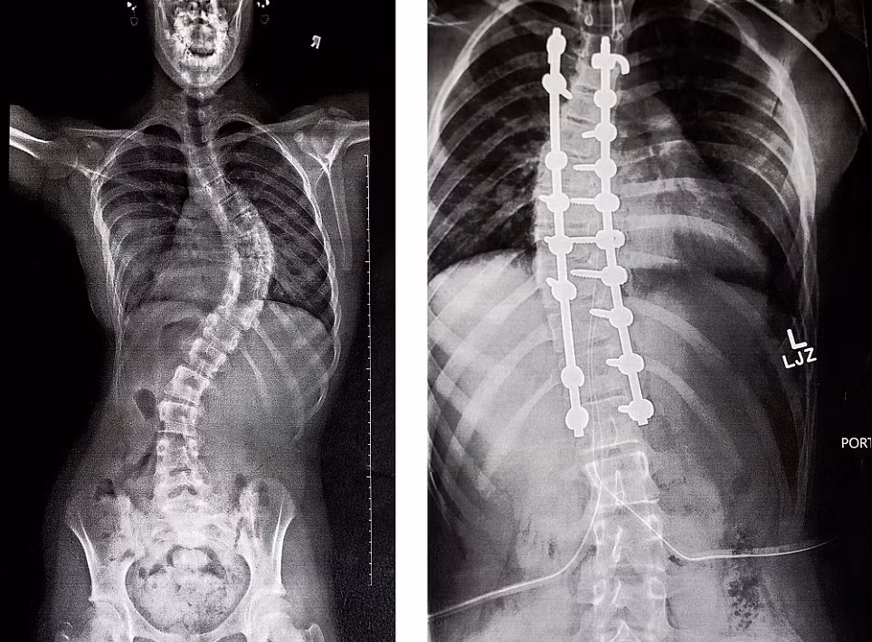 Cột sống của Hannah trước và sau khi phẫu thuật chỉnh hình.