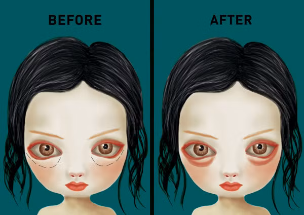 Ngoài việc tạo hiệu ứng bọng mắt khi cười bằng các thủ thuật trang điểm, giờ đây các cô gái trẻ con khiến nhiều người hoảng hốt khi đi tiêm silicone lỏng vào dưới bọng mắt.