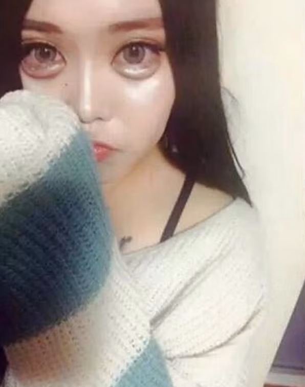 Bên cạnh thực hiện bơm bọng mắt, thiếu nữ này còn khiến khuôn mặt trở nên cứng đờ sau khi gọt mặt nhọn hoắt, nâng mũi, độn trán và phẫu thuật môi trái tim.