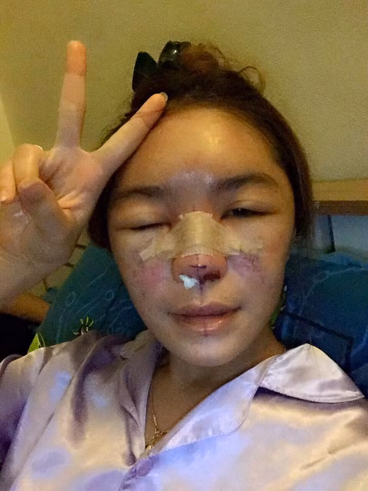 Gai tre suyt phai cat mui vi bien chung phau thuat tham my-Hinh-4