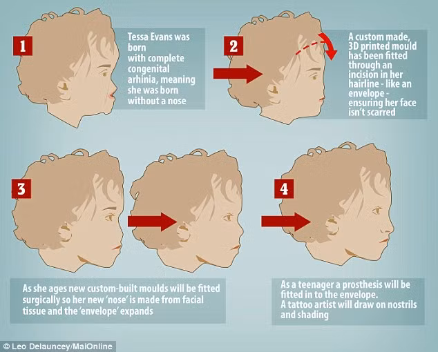 Bé Tessa sẽ phải trải qua nhiều ca phẫu thuật thẩm mỹ chỉnh hàm cũng như cấy ghép mũi để hoàn chỉnh các bộ phận trên khuôn mặt, các ca phẫu thuật cũng còn phụ thuộc vào độ tuổi trưởng thành của bé.