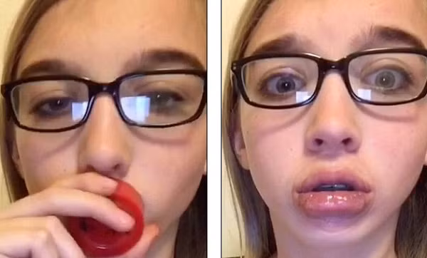 Theo đó, những người tham gia vào trào lưu kì quái này phải đặt miệng vào một chiếc chén, một cái lọ hoặc một đồ dùng có miệng tròn, đáy kín bất kì và dùng hơi sức hút thật mạnh và giữ chặt cho đến khi môi sưng lên. Trào lưu kì quái này sẽ giúp tạo ra những đôi môi sưng vù “thần thánh” như bị ong đốt của Kylie Jenner.