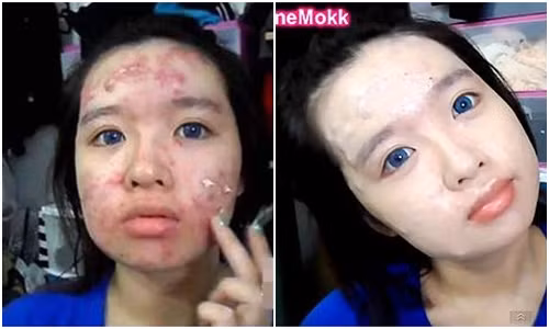 Clip trang diem che mụn rùng rọn khién bác sĩ hét hòn
