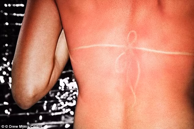 Cháy nắng. Điều này có thể dễ dàng xảy ra khi bạn phơi nắng một vài giờ dưới ánh nắng mặt trời. Làn da sẽ đau nhức khi chạm vào, có thể bị mụn nước, và vài ngày sau da sẽ tự lột. Nếu nặng hơn, bạn có thể phát sốt, lạnh người, đau đầu, choáng ngất, nôn mửa hoặc phát ban. Nếu bị cháy nắng, bạn nên uống nhiều nước, làm ẩm da và giữ da mát bằng cách tắm, chườm lạnh, bôi kem mát da như lô hội, kem dưỡng ẩm… Các loại thuốc chống sưng viêm cũng có tác dụng giảm đau.