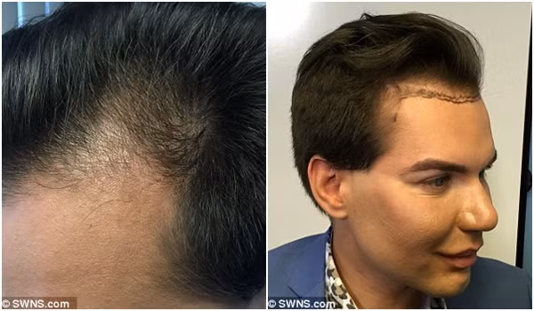 Để thực hiện ca phẫu thuật này, các bác sĩ sẽ tiến hành cắt một mảng da đầu chứa tế bào chân tóc, sau đó cấy xuống phần trán, nơi có tóc để trị chứng hói đầu.