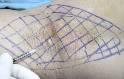 Bước 3, khoanh vùng điều trị hôi nách và tiến hành điều trị.