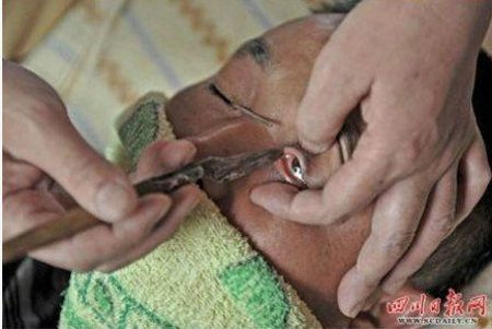 Kinh dị làm sạch tròng mắt bằng dao cạo. Theo lời kể của một người cao tuổi ở Tứ Xuyên, Trung Quốc thì việc làm sạch tròng mắt bằng dao cạo sẽ giúp bạn nhìn cuộc sống một cách rõ ràng hơn. Hình thức làm đẹp này bắt đầu xuất hiện từ thời cổ đại. Nó được phổ biến bởi hai anh em Zhou Chengfu và Zhou Chengyin. Ngày nay, cách làm sạch mắt đặc biệt này chỉ còn lại ở một số nơi tại Tứ Xuyên và Thành Đô.