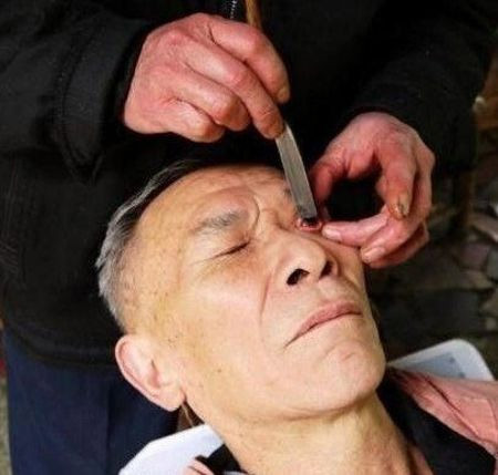 Trước khi làm sạch mắt cho khách hàng, người thợ sẽ nhúng qua cây dao cạo trong nước. Tiếp theo, anh dùng tay trái giữ cho mắt của khách luôn mở trong khi tay phải điều chỉnh con dao qua lại trong mí mắt và nhãn cầu của họ. Sau đó, anh dùng một thanh kim loại lướt qua lướt lại bên trong mí mắt trên và dưới của khách. Việc làm sạch mắt chỉ mất khoảng 5 phút và khi kết thúc, trên mặt khách hàng sẽ giàn giụa nước mắt.