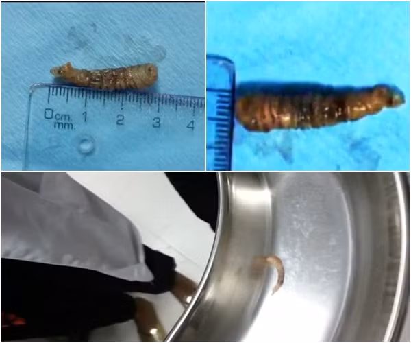 Kinh hoang con sau dai 3cm ky sinh trong mat benh nhan-Hinh-2