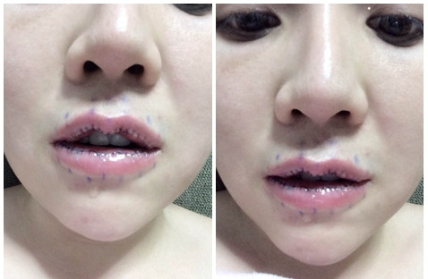 Vết thương vẫn sưng phồng, chảy nước sau 3 ngày thực hiện ca phẫu thuật mỏng môi.