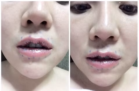 Vết thương vẫn sưng phồng, chảy nước sau 3 ngày thực hiện ca phẫu thuật mỏng môi.