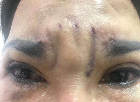 Sẹo đầy trên trán chị L.