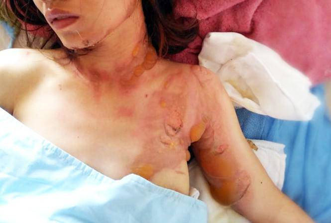 Nguoi phu nu bi chan xe, tat xang phong hoa gay bong nang