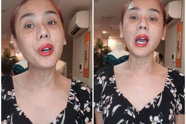 Xuất hiện gần đây, "nữ hoàng chuyển giới" gây sốc với gương mặt nhăn nheo, sần sùi do mới đi tân trang vùng mặt và cổ.