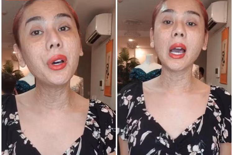 Xuất hiện gần đây, "nữ hoàng chuyển giới" gây sốc với gương mặt nhăn nheo, sần sùi do mới đi tân trang vùng mặt và cổ.