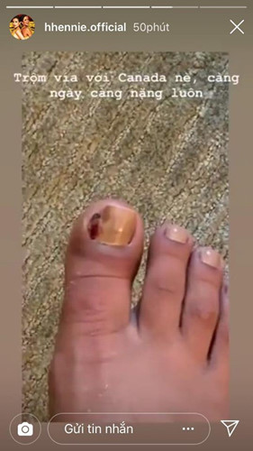 H'hen Niê đăng ảnh ngón chân bị đau, sưng tấy nên cô phải mang dép hở ngón.