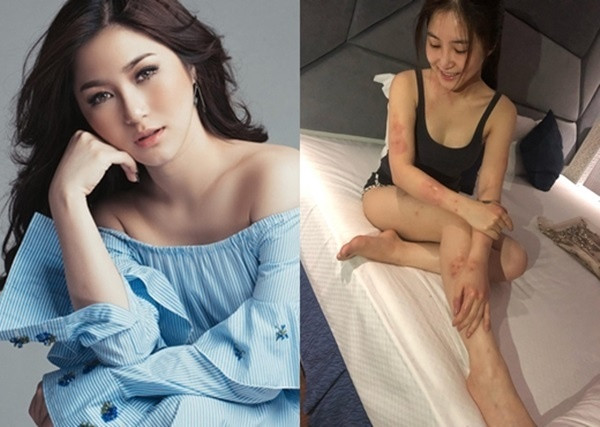 Căng thẳng cũng khiến Hương Tràm dễ bị dị ứng cấp tính, mắc nhiều vấn đề về sức khỏe. Ảnh: FBNV.