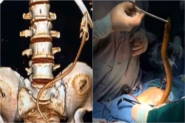 Gap hoa dang so vi nhet luon vao hau mon chua tao bon