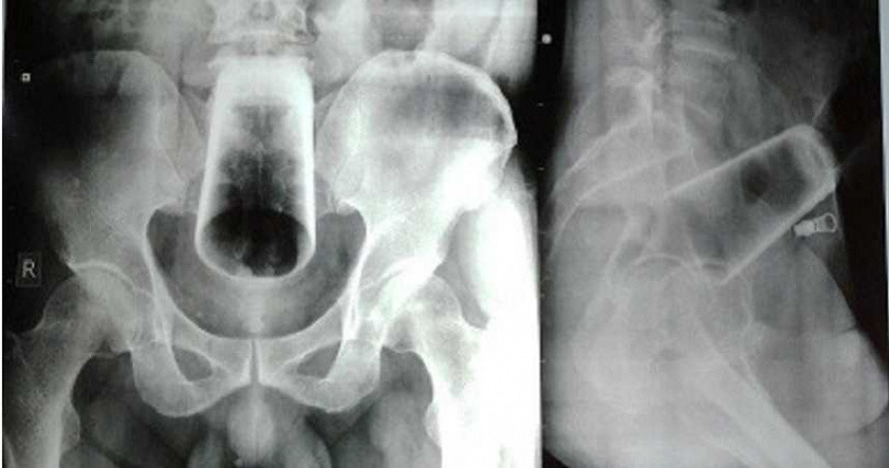 Say ruou, nguoi dan ong nhet coc vao hau mon khien bac si hoang