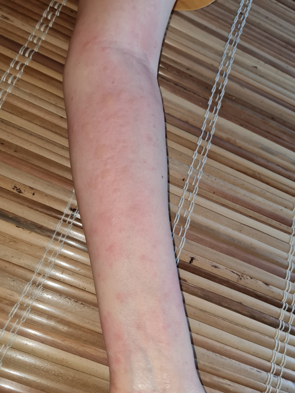 Một bệnh nhân bị sốc phản vệ sau khi bị kiến xoan đốt với các biểu hiện hạ huyết áp, vật vã, nổi mề đay toàn cơ thể, buồn nôn, đi ngoài...Trong tình huống này, cần đưa ngay bệnh nhân đi cấp cứu. Ảnh: Tri thức và Cuộc sống.